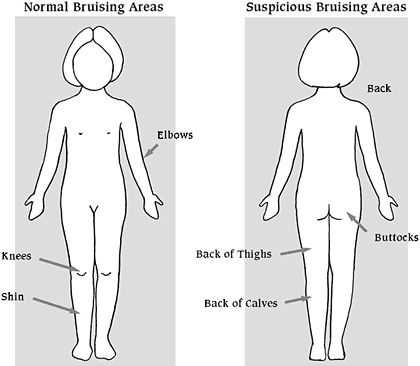 Assessing injuries for possible indications of child abuse