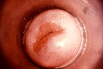 View of cervix showing gonorrhea infection