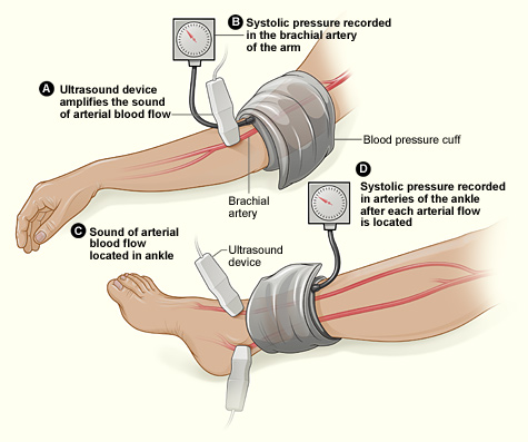 Illustration showing steps for obtaining an ABI