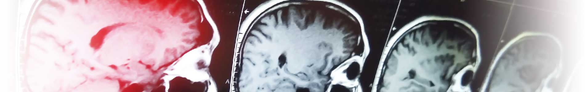 X-ray image of three skulls one with red brain region showing pediatric abusive head trauma