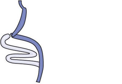 Illustration showing biliopancreatic diversion with duodenal switch for treating obesity