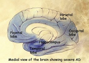 Damaged areas in the brain during late-stage AD